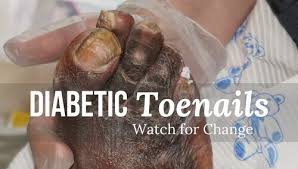 diabetic toenails watch for change wcei