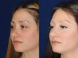 Some people who want this done have a wide nose, some want to. Non Surgical Nose Job After Rhinoplasty Fillers After Rhinoplasty Beverly Hills