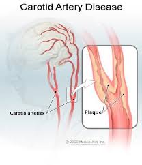 The carotid system of arteries and the jugular system of veins. Carotid Artery Disease Symptoms Treatment Life Expectancy Causes