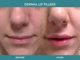 lip fillers berman cosmetic surgery
