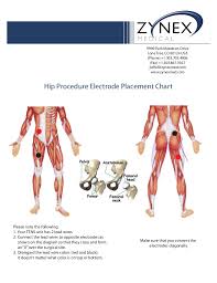 69 Rigorous Estim Electrode Placement Chart