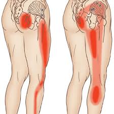 Self Care For Hip And Glute Pain Call West Suburban Pain
