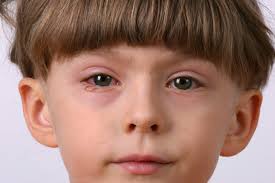 eye discharge and drainage causes and