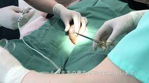 ＧＩＤ(性転換手術)：睾丸摘出｜静岡美容外科橋本クリニック