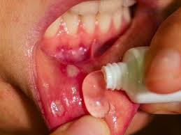are benign mouth lesions mostly cancerous