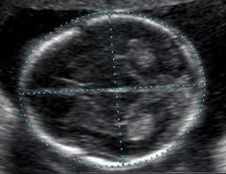 Normal 2nd Trimester Ultrasound How To