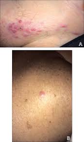 aggressive merkel cell carcinoma in a