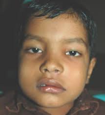 boy showing diffuse swelling