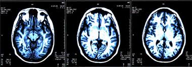 Classification Of Traumatic Brain Injury Acnr Online