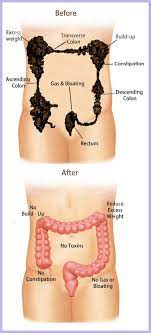 colon cleansing hydrotherapy