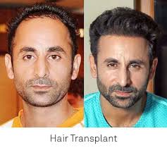 hair transplant cost in delhi