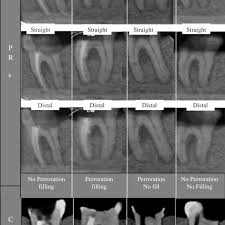 periapical radiographs and cone beam ct