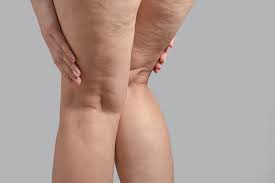cellulite and stretch marks