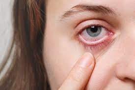 recognise treat eye infections