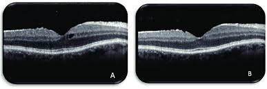 asymptomatic cystic macular edema four