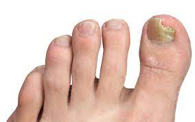 how does toenail fungus form and how