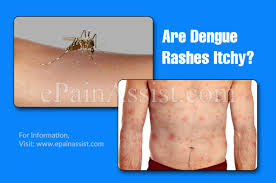 Symptoms of dengue usually develop suddenly, about 5 to 8 days after you become infected. Are Dengue Rashes Itchy How Long Does Dengue Last