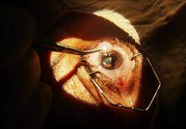 cataract surgery what it is what to