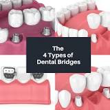 Image result for bridges dental approach