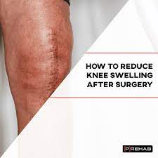 reduce knee swelling after surgery