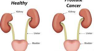 prostate cancer is diagnosed by digital rectal exam, prostate specific antigen (psa) test, and prostate biopsy. Prostate Cancer Symptoms Causes And Treatment Article1000 Com