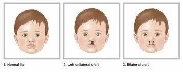 cleft lip cleft palate at best
