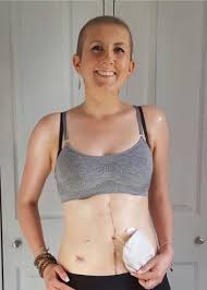It is more common than bloating in the tummy (abdomen) that does not go away (rather than bloating that comes and whether the cancer has spread to other areas of the body (metastasised). My Bloating Turned Out To Be Ovarian Cancer I Was 30 Healthista