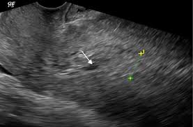 role of transinal ultrasound in