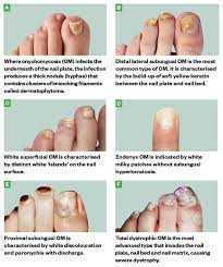 toenail fungus onychomycosis or tinea