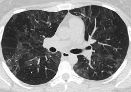 Noninfectious Inflammatory Lung Disease