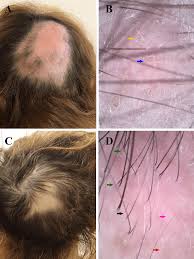 platelet rich plasma in alopecia areata