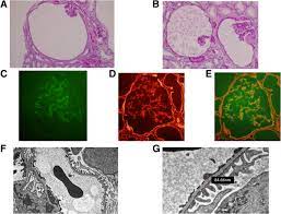 Sporadic Glomerulocystic Kidney Disease