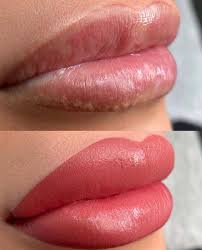 what are fordyce spots on lips causes