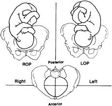 Fetal Occipito Posterior Op Position There Are Three Op