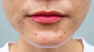 how to deal with hormonal acne as an