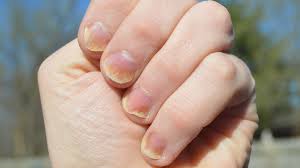 dealing with nail psoriasis here s how