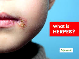 what is herpes know its types causes