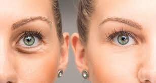 crows feet what is it and how to treat