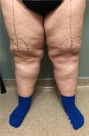 thigh liposuction sacramento norcal