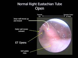 (nor do most people who recommended the practice in the first place.) all they know is that chewing gum seems to stop your ears from crackling, making for a more pleasant flight. Ear Disorders Eustacian Tube Dysfunction California Ear Institute Ear Doctors Palo Alto Bay Area