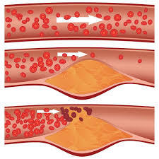 coronary artery disease atherosclerosis