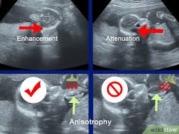 Melalui hasil usg, dokter dan ibu hamil dapat mengetahui kondisi janin dalam kandungan. Cara Membaca Foto Usg 8 Langkah Dengan Gambar Wikihow