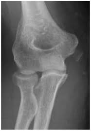 Medial epicondyle entrapment after an acute fracture dislocation of the elbow is a common finding in the pediatric population, but a rare finding in adults. The Assessment And Management Of Simple Elbow Dislocations