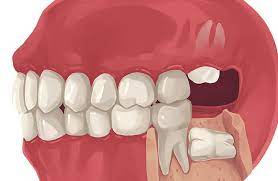 How much does wisdom teeth removal cost? Wisdom Teeth Removal Cost How Much Are Wisdom Teeth Extraction 2021 Frisco Tx Highland Oak Dental