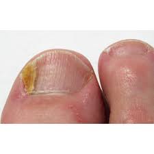 what causes fungal nail infection