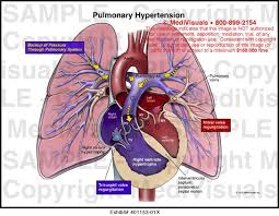 Case study pregnancy induced hypertension  I  Pregnancy Induced  HypertensionII  Introduction Pregnancy Induced Hypertension  PIH  is a  condition    