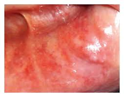 erythematosus lichenoid lesion of