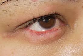 lupus rash symptoms causes treatment