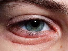 irritated eyes tips for managing an