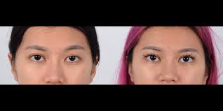 ptosis repair before and after photo